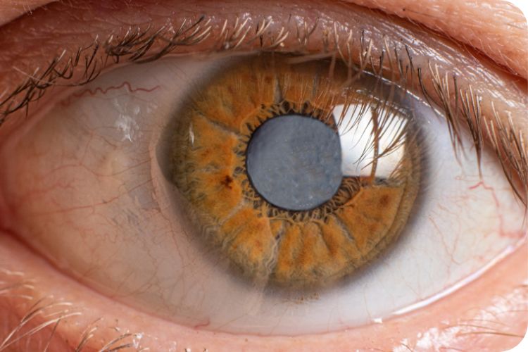 Desafiando las sombras: Conociendo el glaucoma y su impacto en la salud ocular